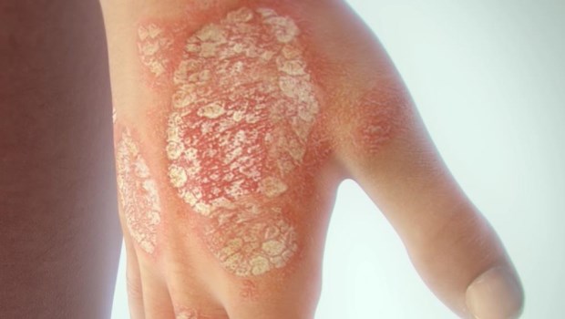 Psoriasis