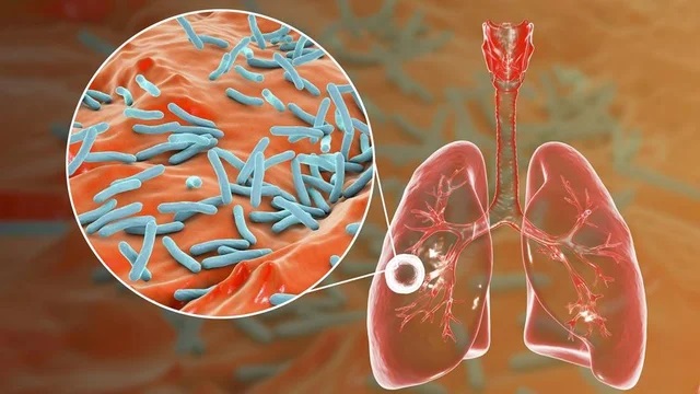 La tuberculosis afecta a los pulmones.